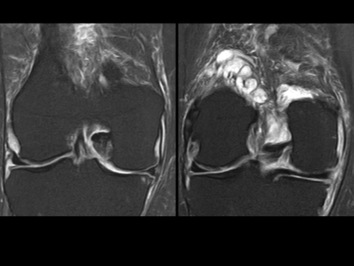 Figure 5 for case Lipoma Arborescens
